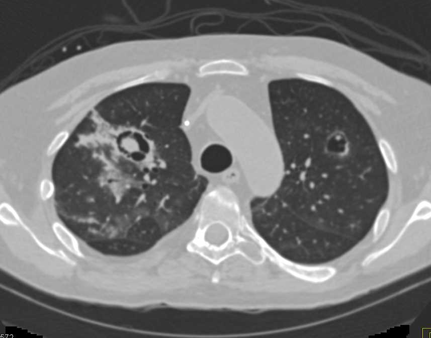 Cavitary Lesions due to Septic Emboli and IVDA - CTisus CT Scan