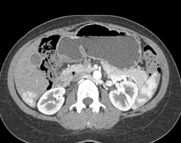 FNH Right Lobe of the Liver - CTisus CT Scan