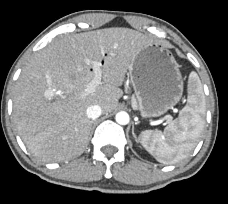 Prior Infarct Right Lobe of the Liver - CTisus CT Scan