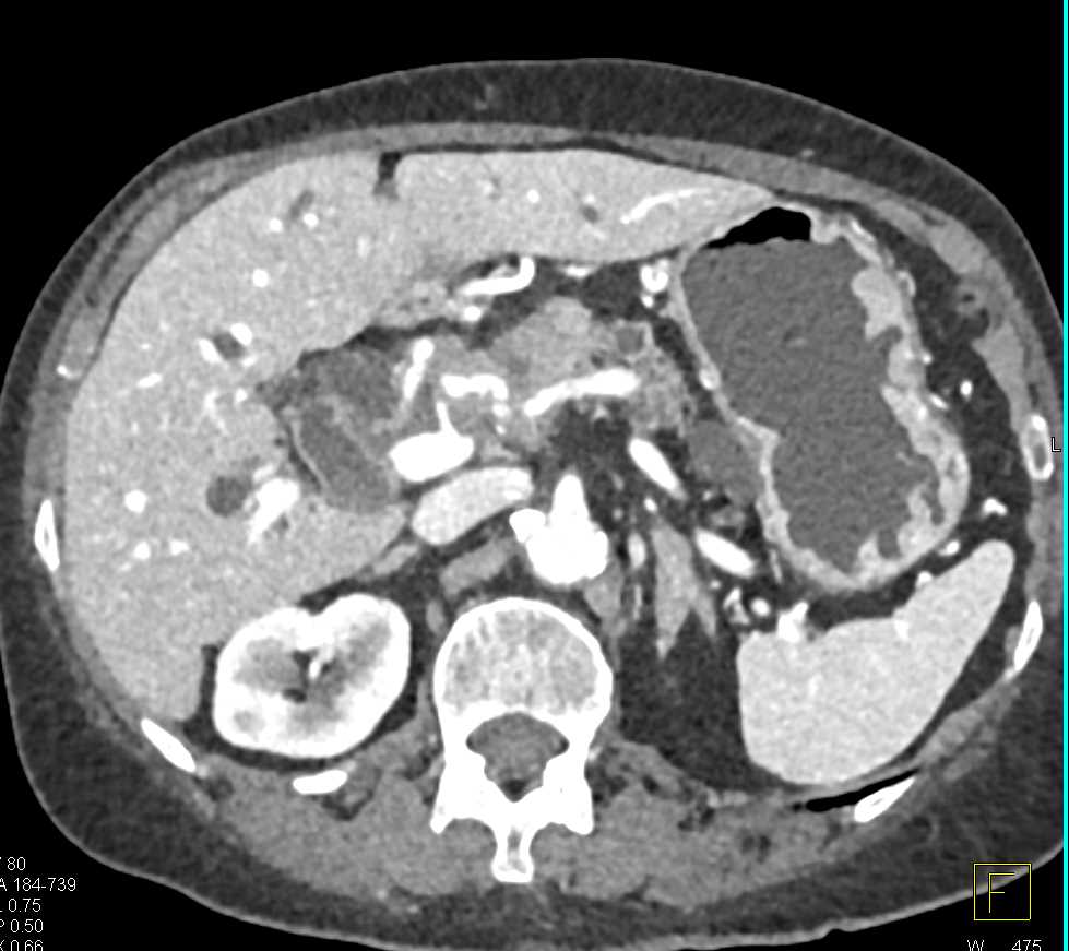 Carcinoma Head of Pancreas with Dilated Pancreatic Duct - CTisus CT Scan