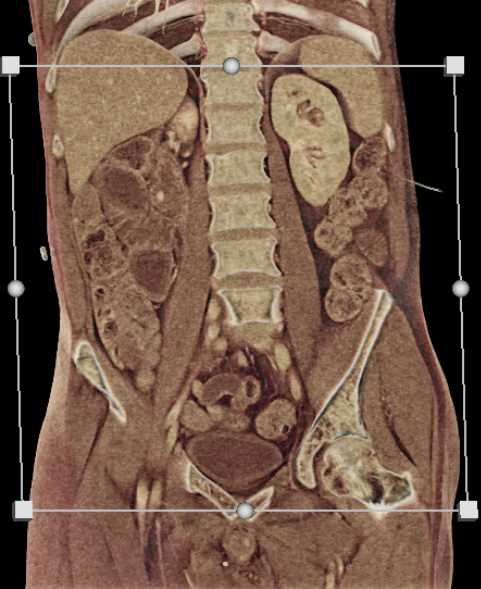 Dilated Small Bowel - CTisus CT Scan