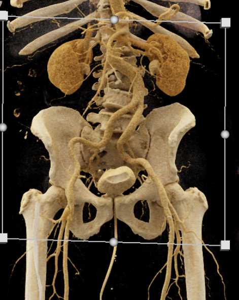 Pseudoaneurysm Right Femoral Artery - CTisus CT Scan