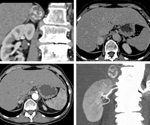 Adrenal Hemangioma CT Findings