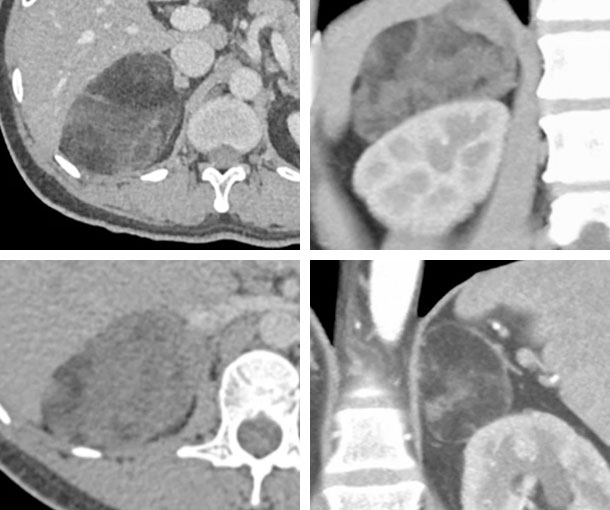 Adrenal Myelolipoma CT Findings