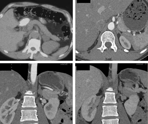Aldosteronoma CT Findings