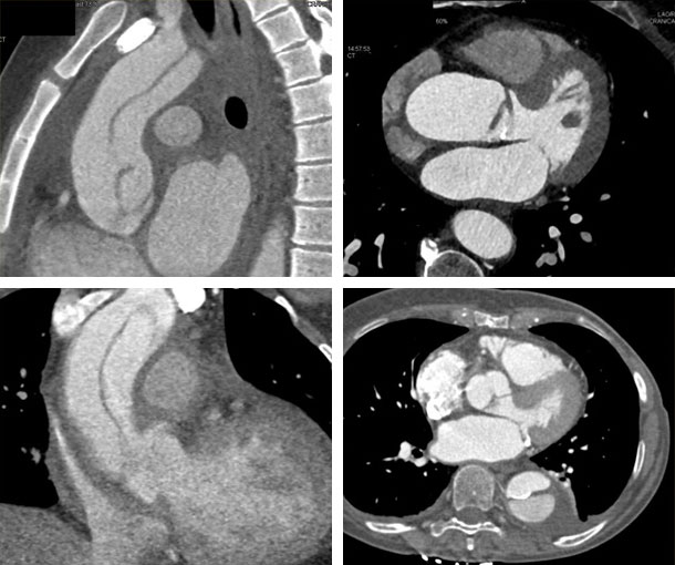 Aortic Dissection CT Findings