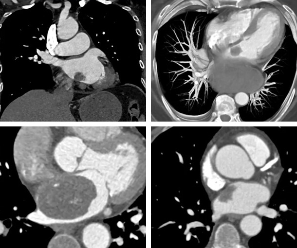 Atrial Myxoma CT Findings