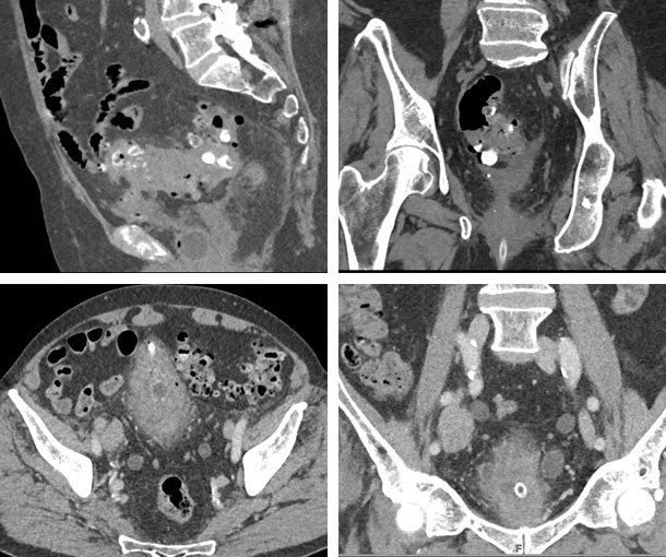 Bladder Diverticulitis CT Findings