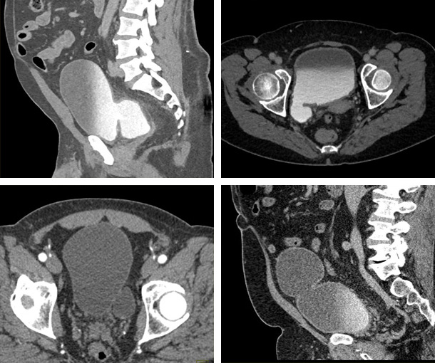 Bladder Diverticulum CT Findings