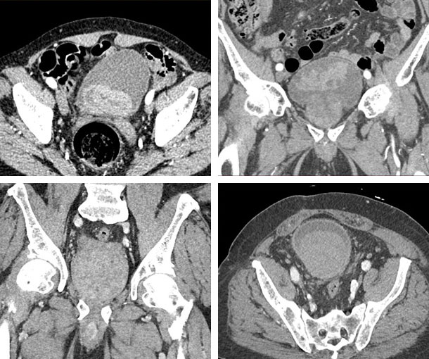 Bladder Hemorrhage CT Findings
