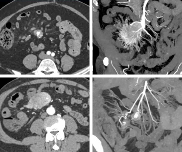 Small Bowel Carcinoid Tumor CT Findings