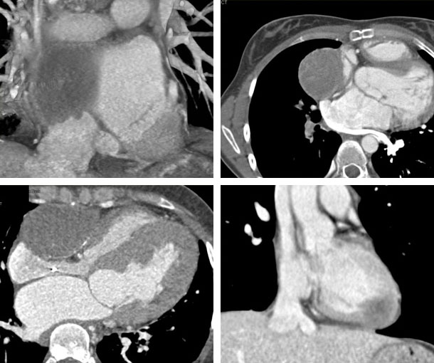 Cardiac Angiosarcoma CT Findings