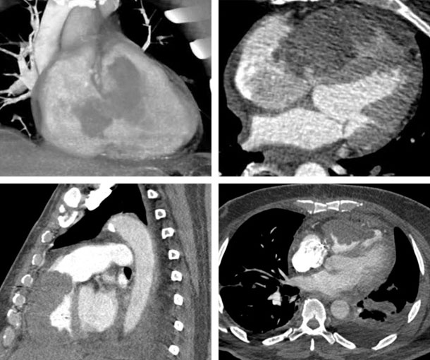 Cardiac Spindle Cell Carcinoma CT Findings
