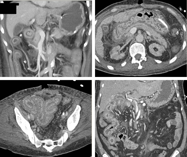 Chemotherapy-Induced Enteritis CT Findings