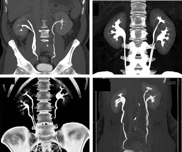 Duplex Kidney CT Findings