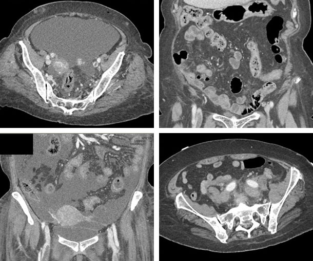 Deep Vein Thrombosis (DVT) CT Findings