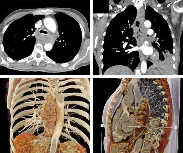Esophageal Squamous Cell Carcinoma CT Findings