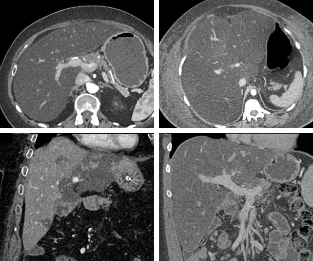 Fatty Liver Disease CT Findings