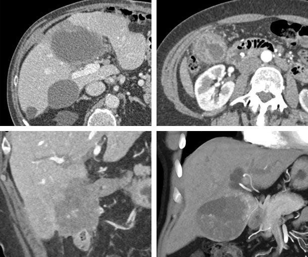 Gallbladder Carcinoma CT Findings