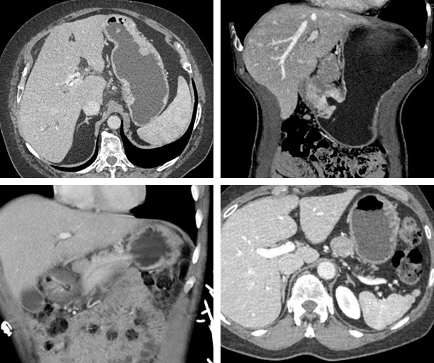 Gastric Adenocarcinoma CT Findings