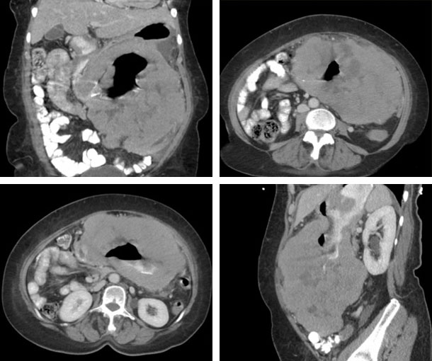 Gastric Lymphoma CT Findings