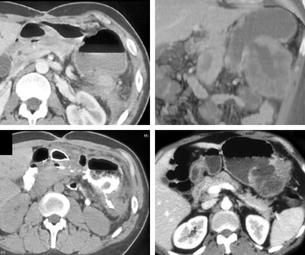 Gastrocolic Fistula CT Findings