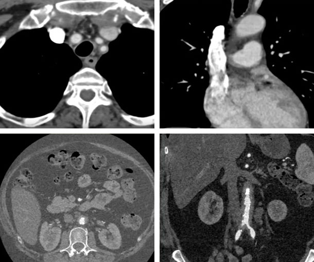 Giant Cell Arteritis CT Findings