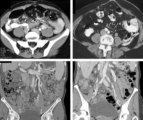 Gonadal Vein Thrombosis (GVT) CT Findings