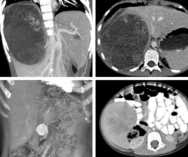Hepatoblastoma CT Findings