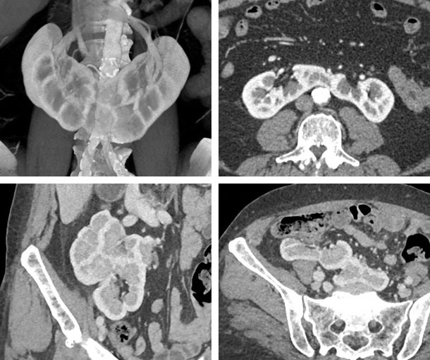 Horseshoe Kidney CT Findings
