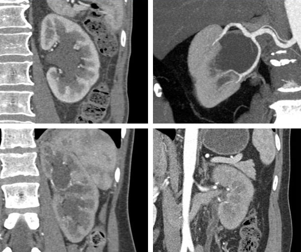 Hydronephrosis CT Findings