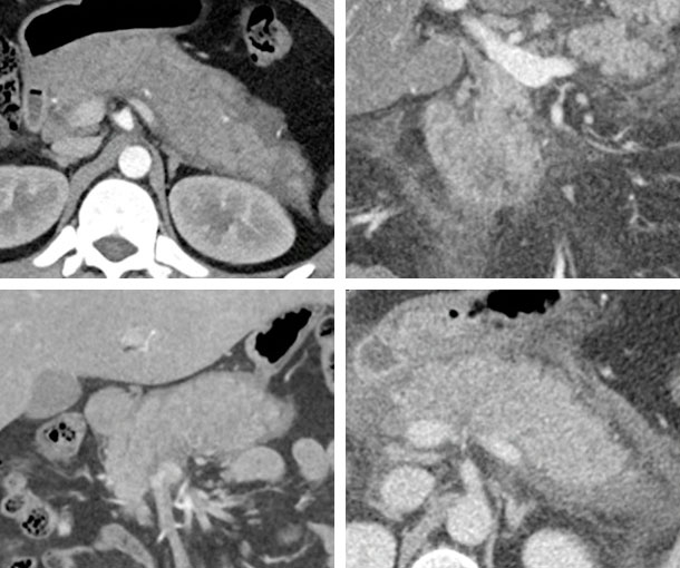 Interstitial Edematous Pancreatitis (IEP) CT Findings
