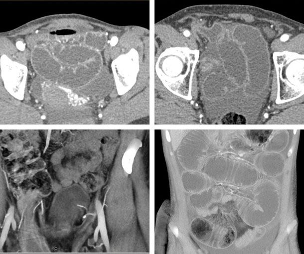 Inguinal Hernia CT Findings