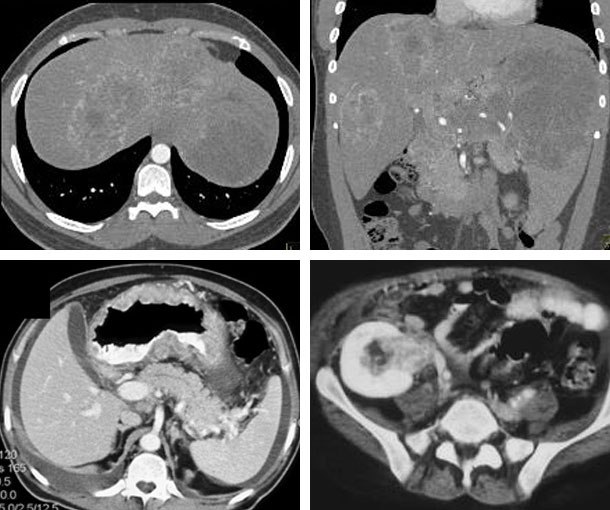 Kaposi Sarcoma CT Findings