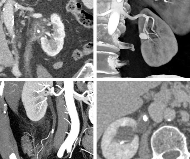 Kidney Stone Disease CT Findings