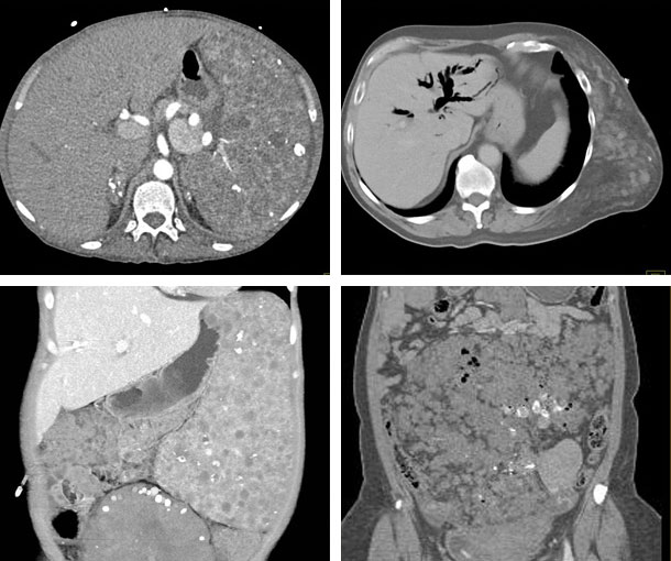 Klippel-Trenaunay Syndrome (KTS) CT Findings