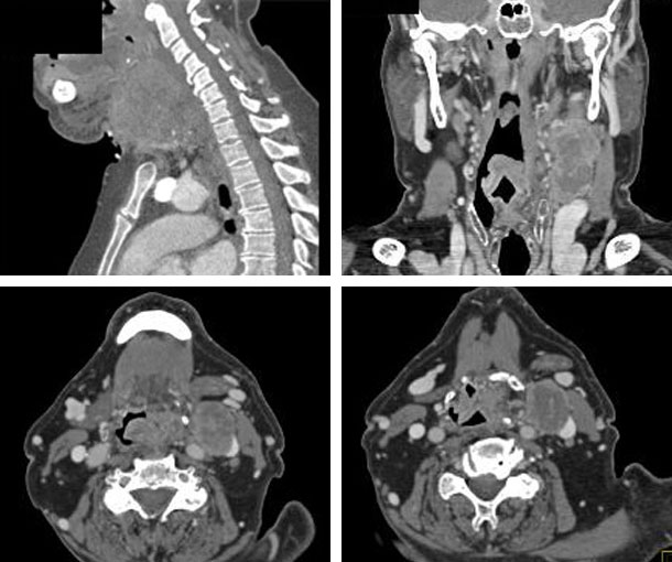 Laryngeal Cancer CT Findings