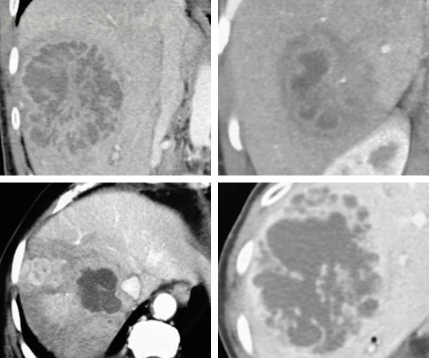 Liver Abscess CT Findings