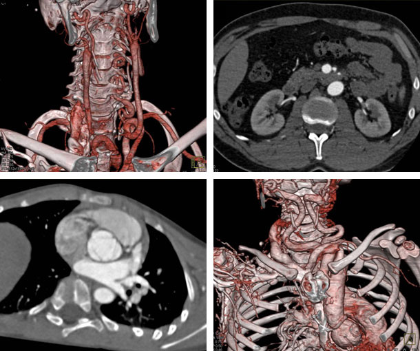 Loeys-Dietz Syndrome (LDS) CT Findings