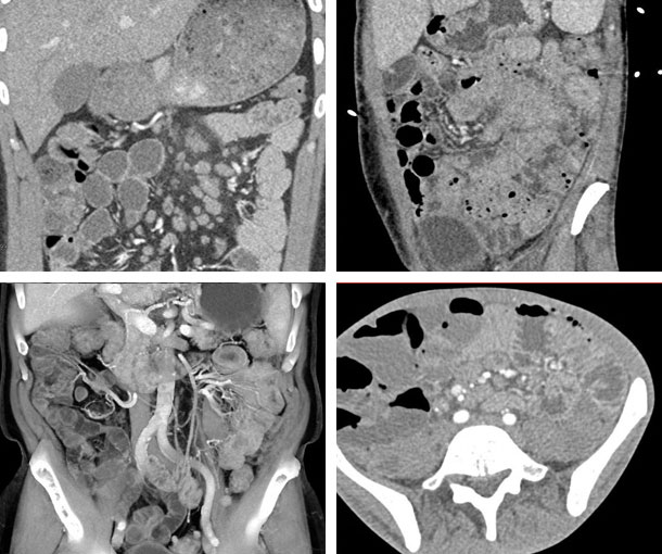 Mycobacterium Avium-Intracellulare (MAI) CT Findings
