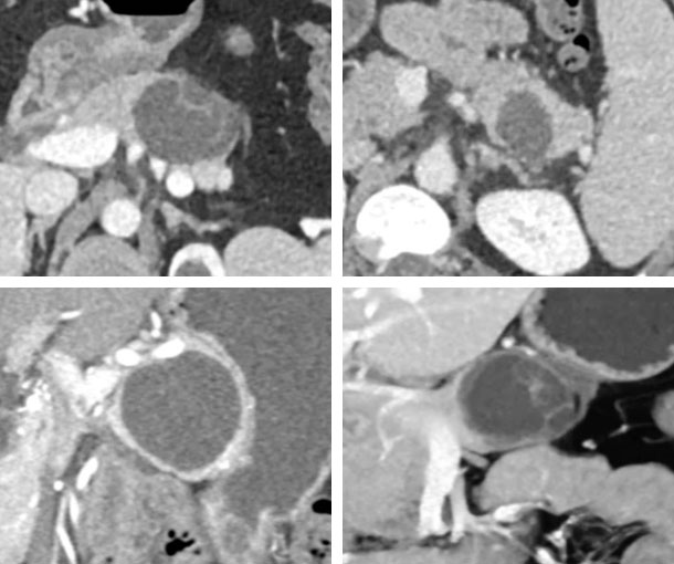 Mucinous Cystic Neoplasm (MCN) CT Findings