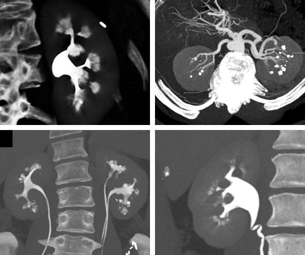 Medullary Sponge Kidney CT Findings
