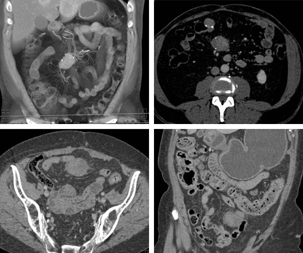Mesenteric Desmoid Tumor CT Findings