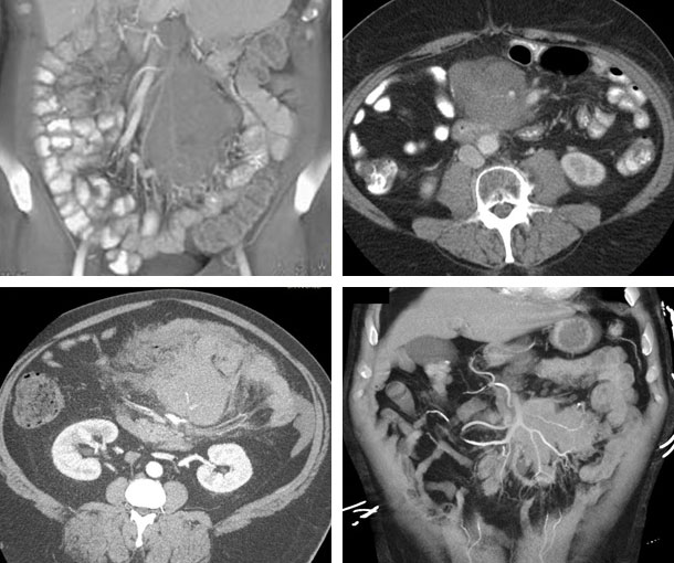 Mesenteric Lymphoma CT Findings