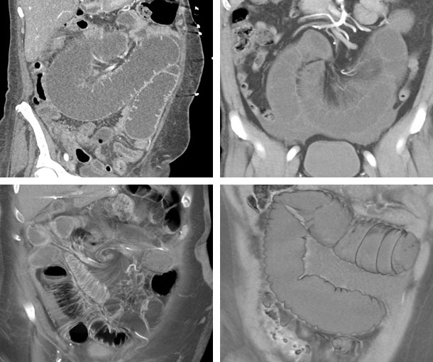 Midgut Volvulus CT Findings
