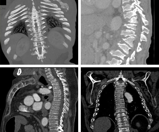Morquio Syndrome CT Findings