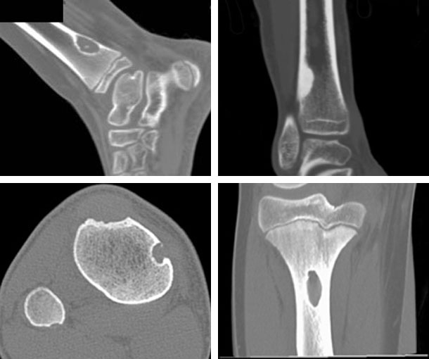 Non-Ossifying Fibroma CT Findings