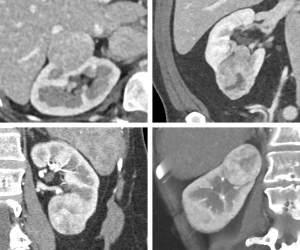 Oncocytoma CT Findings