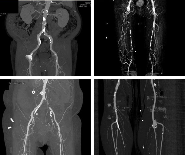 Peripheral Arterial Disease (PAD) CT Findings