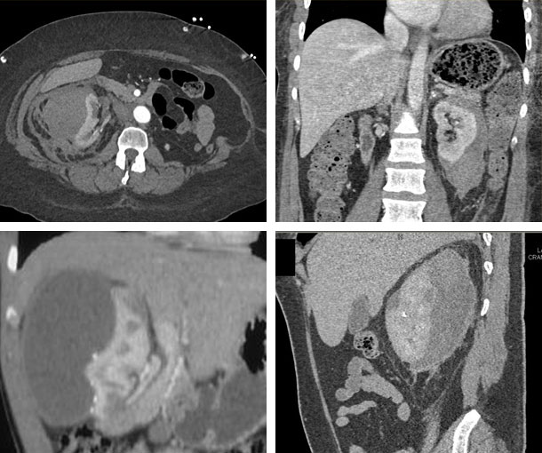 Page Kidney CT Findings